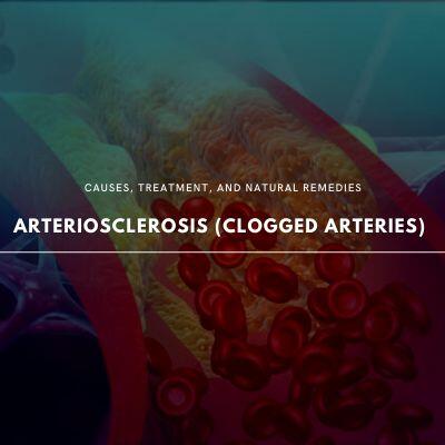 Understanding Arteriosclerosis: Causes, Symptoms, and Natural Remedies